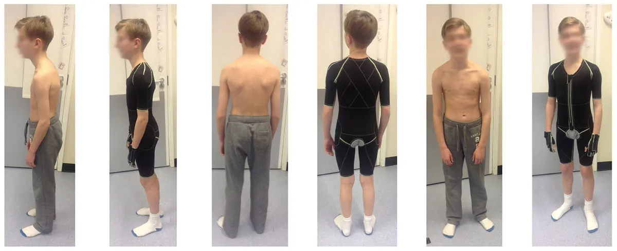 Case-Study-Benign-Hypermobility